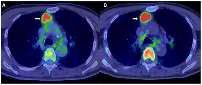 Amino Acid and Proliferation PET/CT for the Diagnosis of Multiple Myeloma